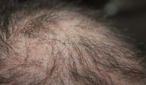 hair loss